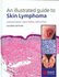 Book: An Illustrated Guide to Skin Lymphoma Helmut Kerl, Hardcover